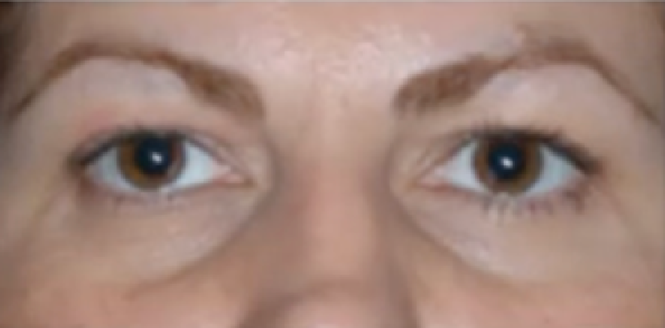 Blepharoplasty – Medivia