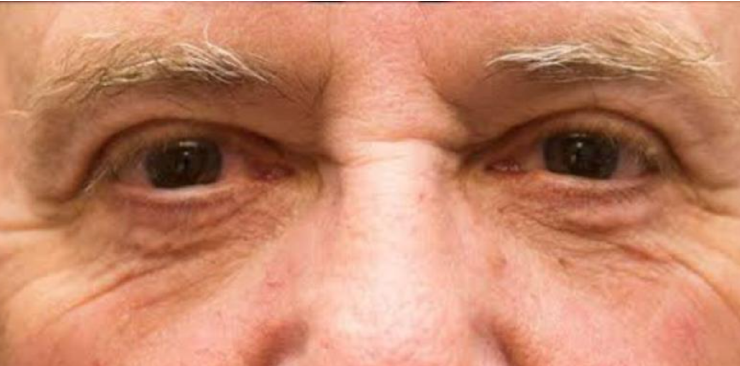 Blepharoplasty – Medivia